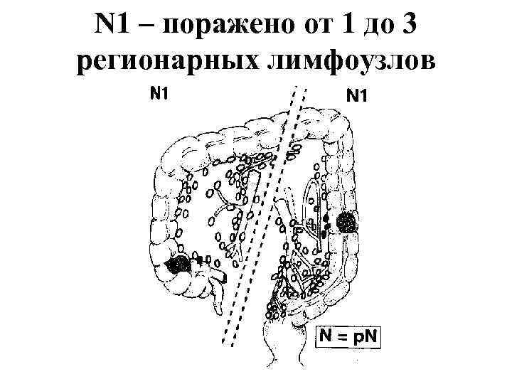 N 1 – поражено от 1 до 3 регионарных лимфоузлов 