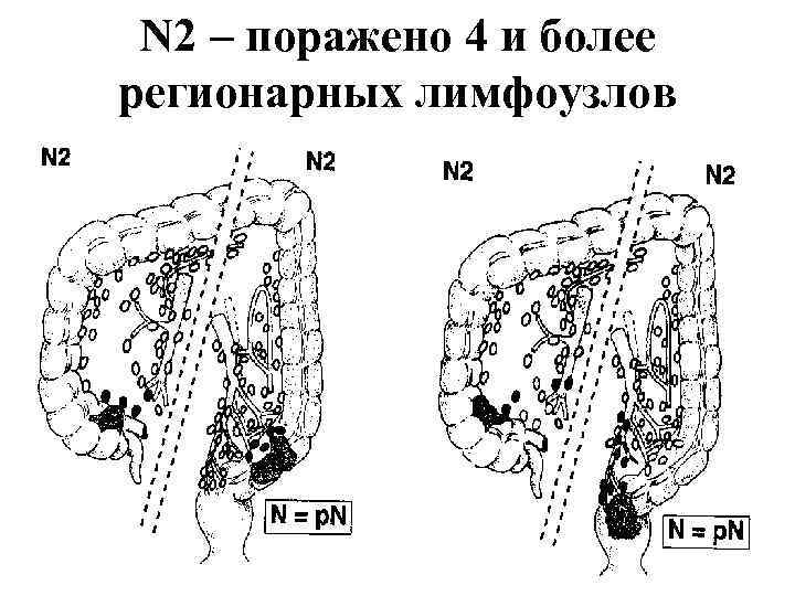 N 2 – поражено 4 и более регионарных лимфоузлов 