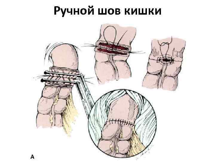 Ручной шов кишки 