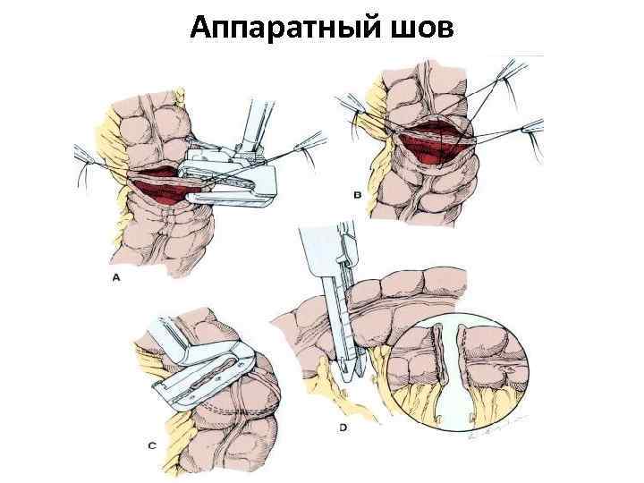 Аппаратный шов 