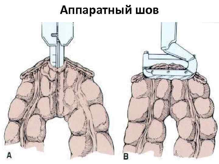 Аппаратный шов 