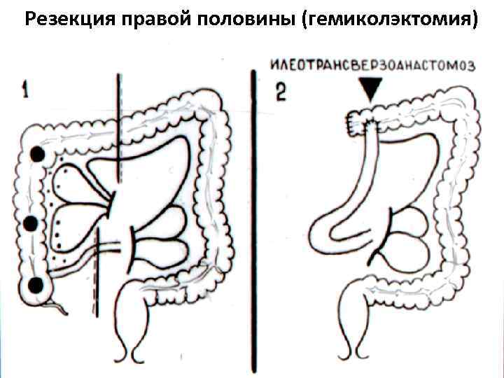 Резекция правой половины (гемиколэктомия) 