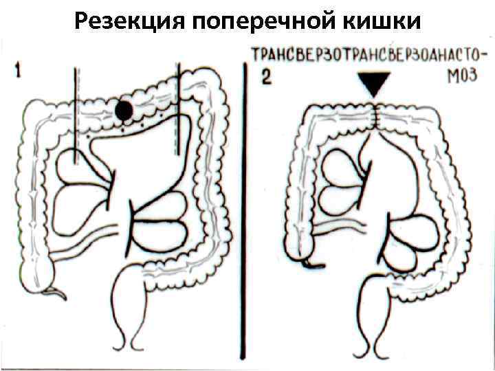 Резекция поперечной кишки 