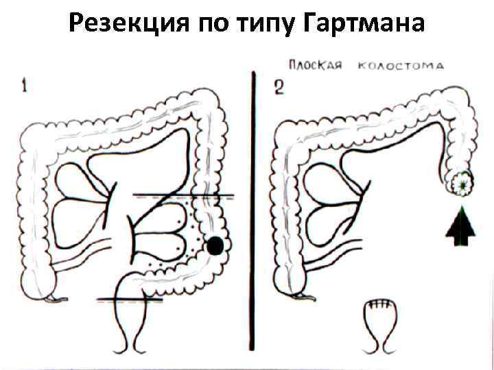 Резекция по типу Гартмана 