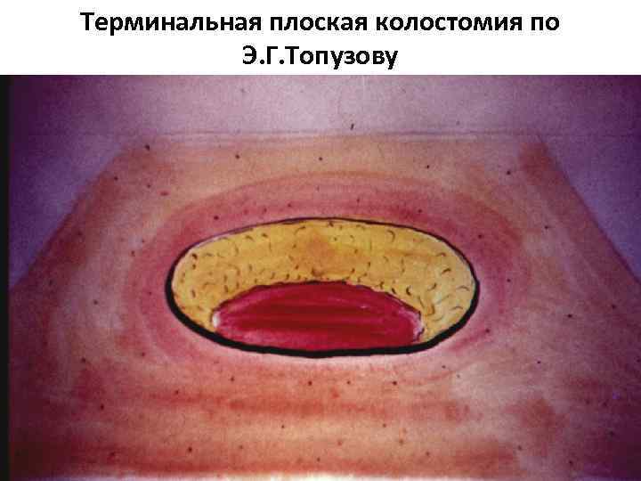 Терминальная плоская колостомия по Э. Г. Топузову 