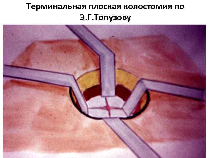 Терминальная плоская колостомия по Э. Г. Топузову 