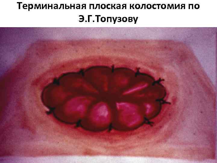 Терминальная плоская колостомия по Э. Г. Топузову 