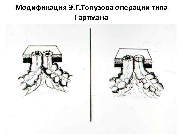 Схема операция гартмана