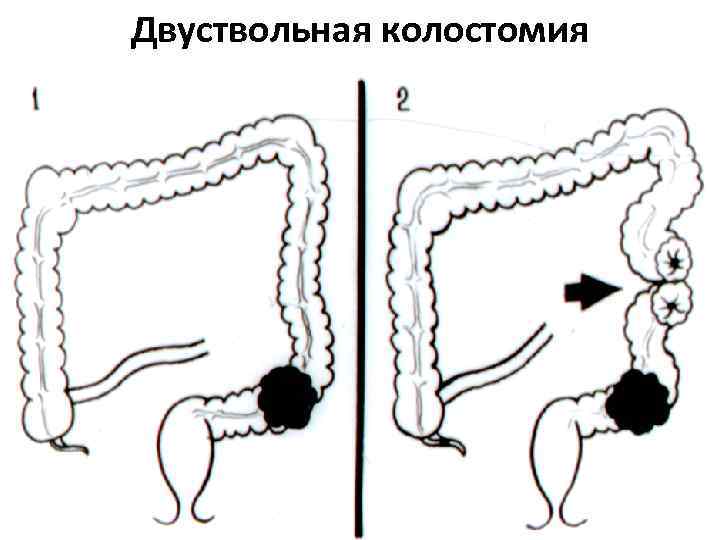 Двуствольная колостомия 