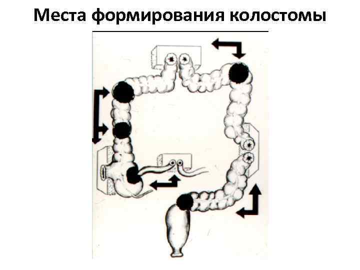 Места формирования колостомы 