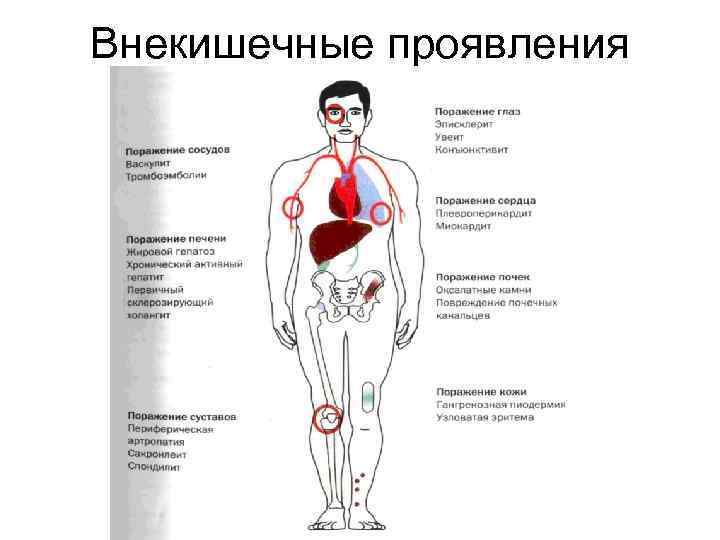 Внекишечные проявления 