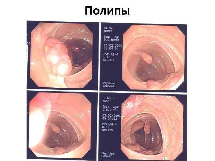 Полипы 