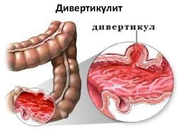 Дивертикулит 