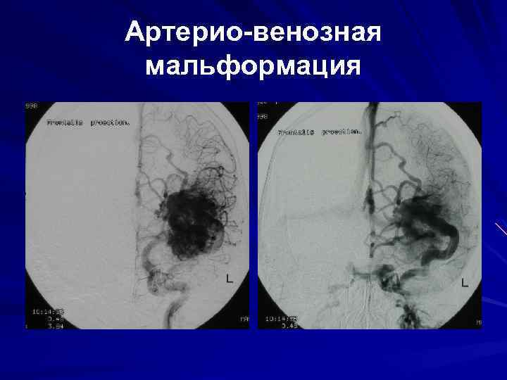 Артерио-венозная мальформация 