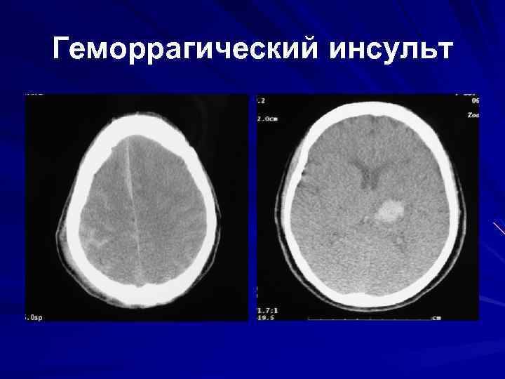 Геморрагический инсульт 