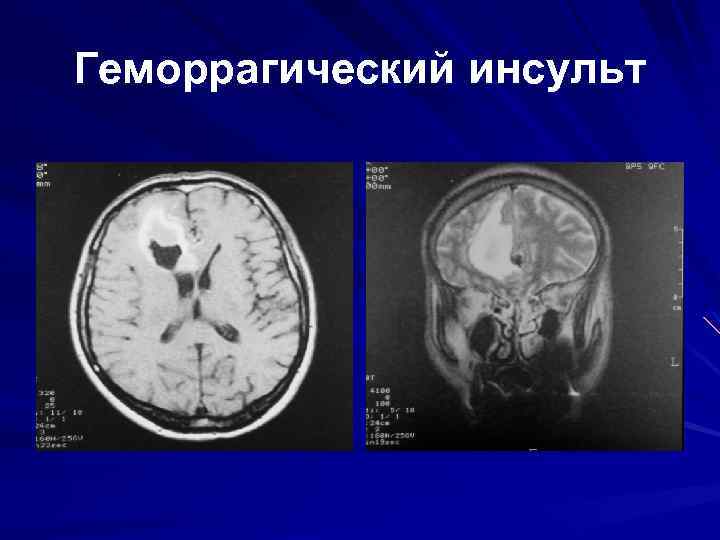 Геморрагический инсульт 