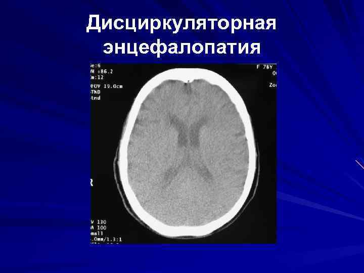 Дисциркуляторные изменения головного мозга что это такое. Дисциркуляторная энцефалопатия головного мозга на кт. Дисциркуляторная энцефалопатия мрт. Дисциркуляторная энцефалопатия на кт на кт. Кт картина дисциркуляторной энцефалопатии.
