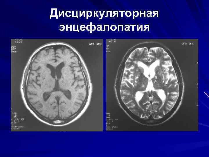 Резидуальные изменения головного мозга. Дисциркуляторная энцефалопатия головного мозга на кт. Энцефалопатия головного мозга на кт. Синдром дисциркуляторной энцефалопатии. Резидуальная энцефалопатия кт.