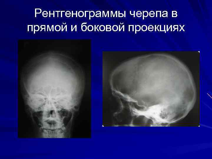 Рентгенограммы черепа в прямой и боковой проекциях 