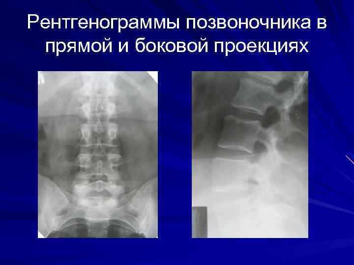 Рентгенограммы позвоночника в прямой и боковой проекциях 