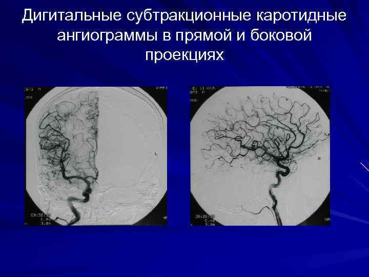 Дигитальные субтракционные каротидные ангиограммы в прямой и боковой проекциях 