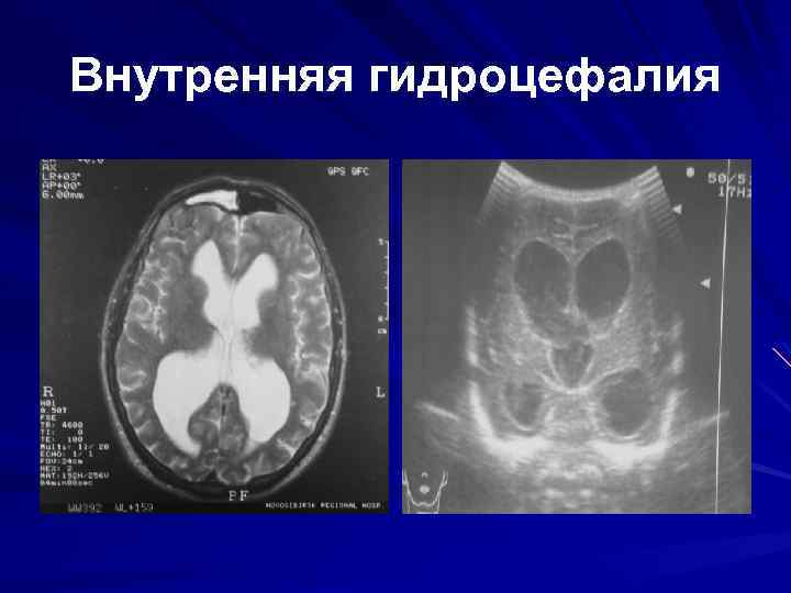 Мр картина умеренной наружной заместительной гидроцефалии что это значит