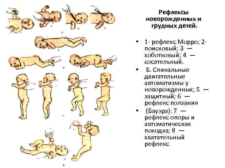 Рефлексы новорожденных и грудных детей. • 1 - рефлекс Морро; 2 поисковый; 3 —