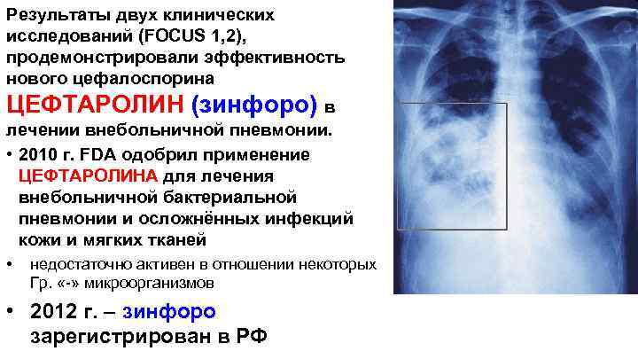 Результаты двух клинических исследований (FOCUS 1, 2), продемонстрировали эффективность нового цефалоспорина ЦЕФТАРОЛИН (зинфоро) в
