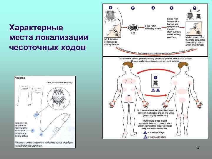 Характерные места локализации чесоточных ходов 12 