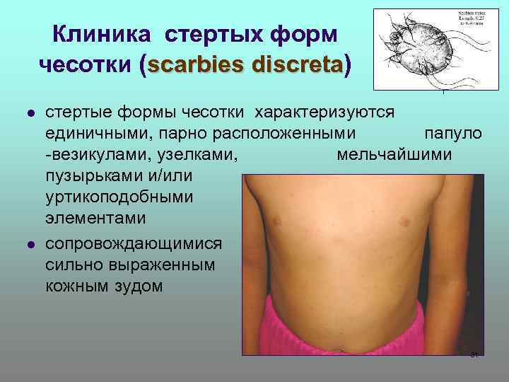 Клиника стертых форм чесотки (scarbies discreta) l l стертые формы чесотки характеризуются единичными, парно