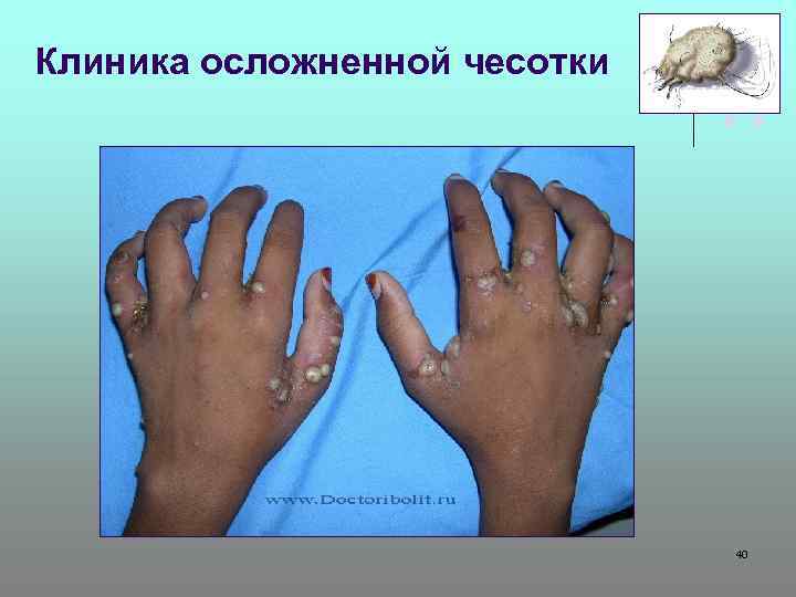 Клиника осложненной чесотки 40 