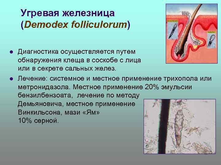 Угревая железница (Demodex folliculorum) l l Диагностика осуществляется путем обнаружения клеща в соскобе с