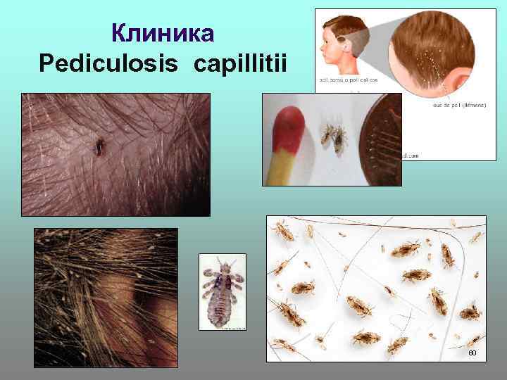 Клиника Pediculosis capillitii 60 