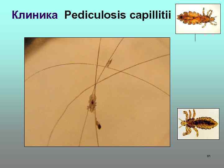 Клиника Pediculosis capillitii 61 