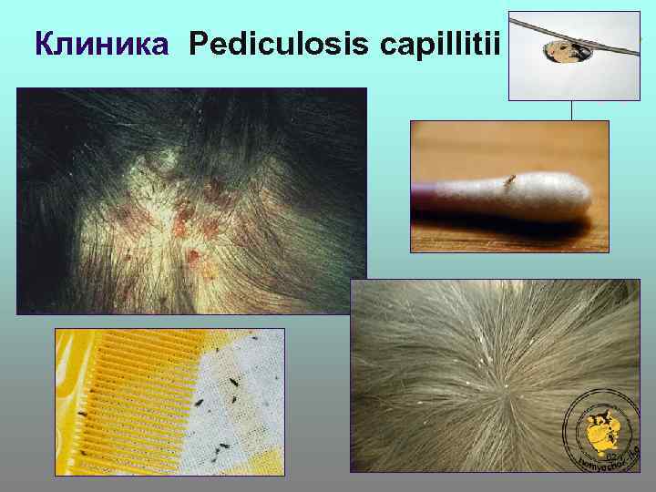 Клиника Pediculosis capillitii 62 