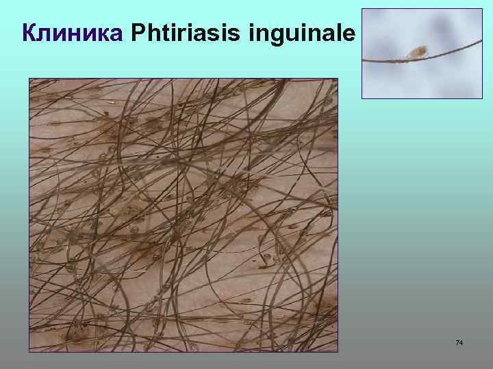 Клиника Phtiriasis inguinale 74 