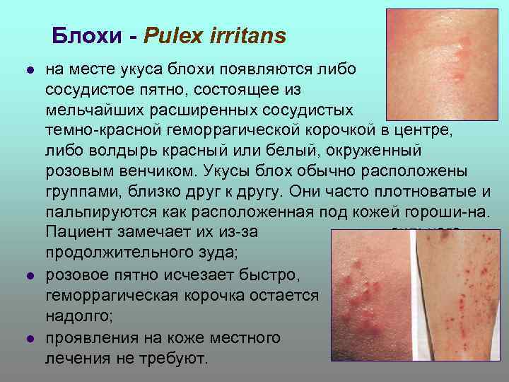 Блохи - Pulex irritans l l l на месте укуса блохи появляются либо розовое