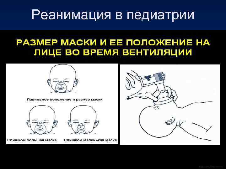 Реанимация в педиатрии 