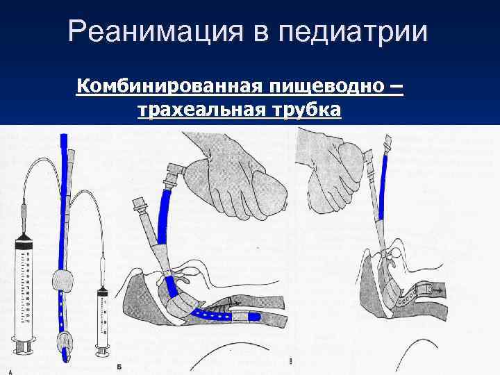 Реанимация в педиатрии Комбинированная пищеводно – трахеальная трубка 