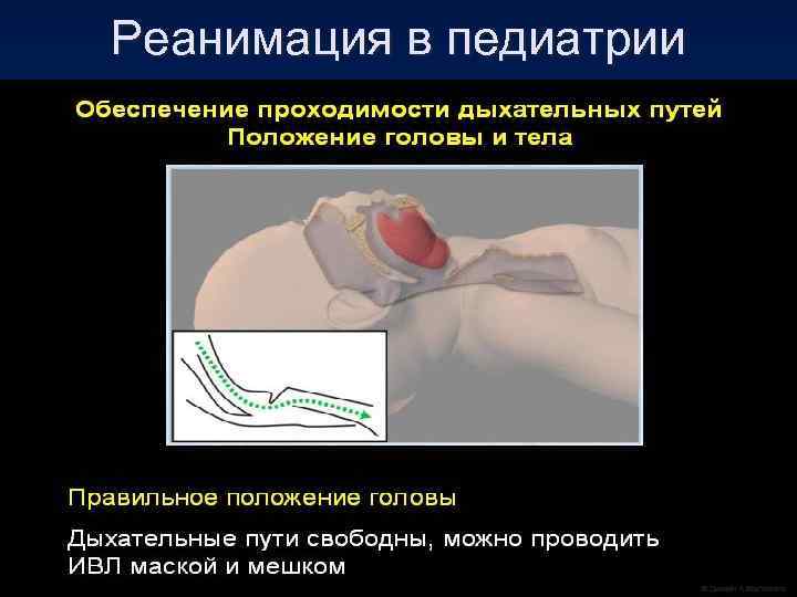 Реанимация в педиатрии 