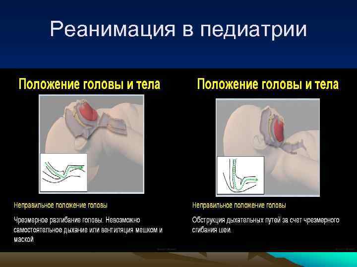 Реанимация в педиатрии 