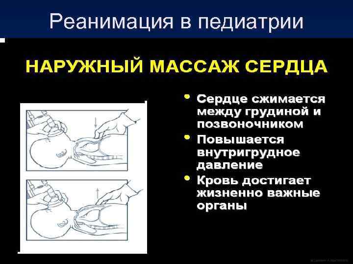 Реанимация в педиатрии 