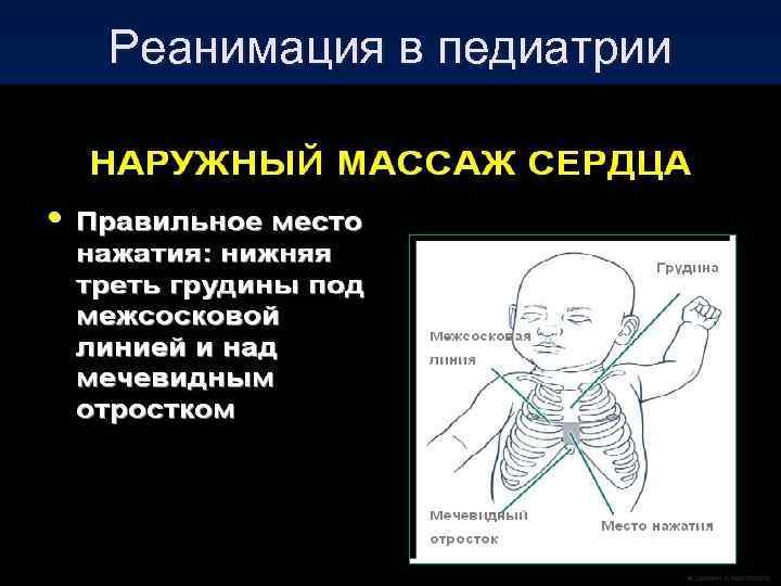 Реанимация в педиатрии 