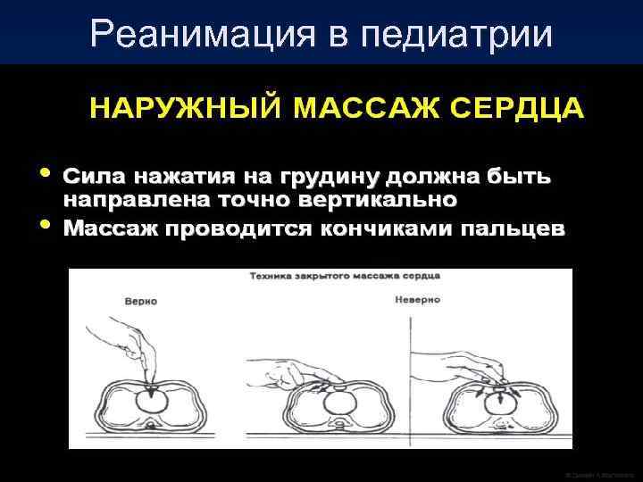 Реанимация в педиатрии 