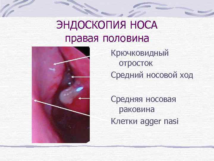 ЭНДОСКОПИЯ НОСА правая половина Крючковидный отросток Средний носовой ход Средняя носовая раковина Клетки agger