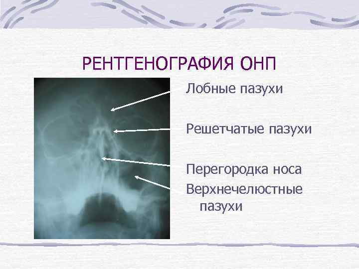 РЕНТГЕНОГРАФИЯ ОНП Лобные пазухи Решетчатые пазухи Перегородка носа Верхнечелюстные пазухи 