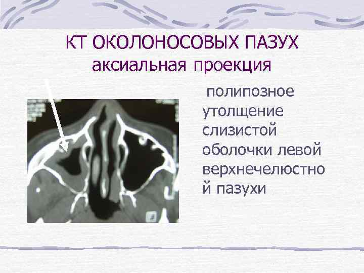 КТ ОКОЛОНОСОВЫХ ПАЗУХ аксиальная проекция полипозное утолщение слизистой оболочки левой верхнечелюстно й пазухи 