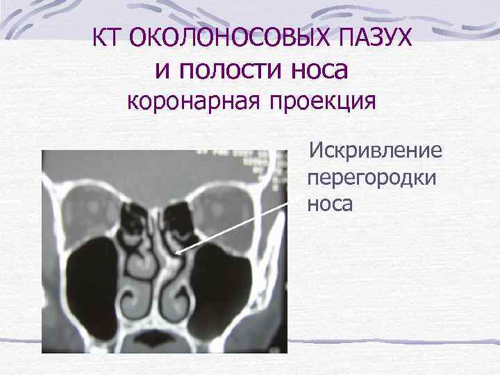 КТ ОКОЛОНОСОВЫХ ПАЗУХ и полости носа коронарная проекция Искривление перегородки носа 