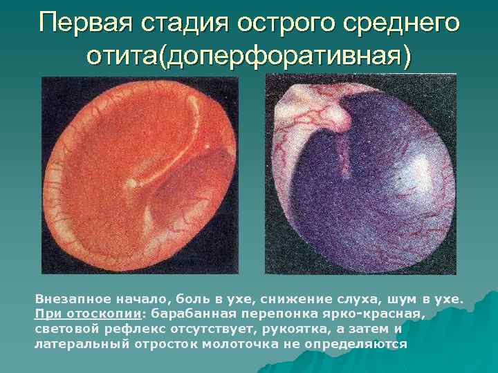 Первая стадия острого среднего отита(доперфоративная) Внезапное начало, боль в ухе, снижение слуха, шум в