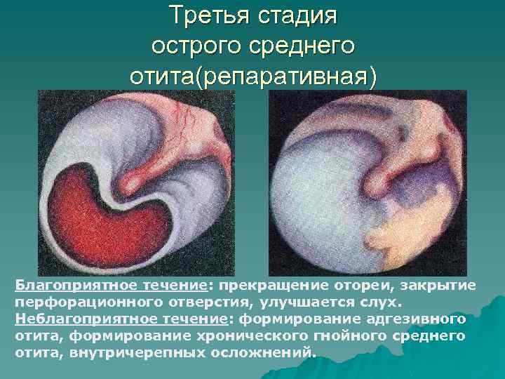 Третья стадия острого среднего отита(репаративная) Благоприятное течение: прекращение отореи, закрытие перфорационного отверстия, улучшается слух.